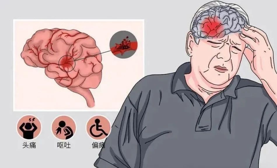 脑出血.jpg